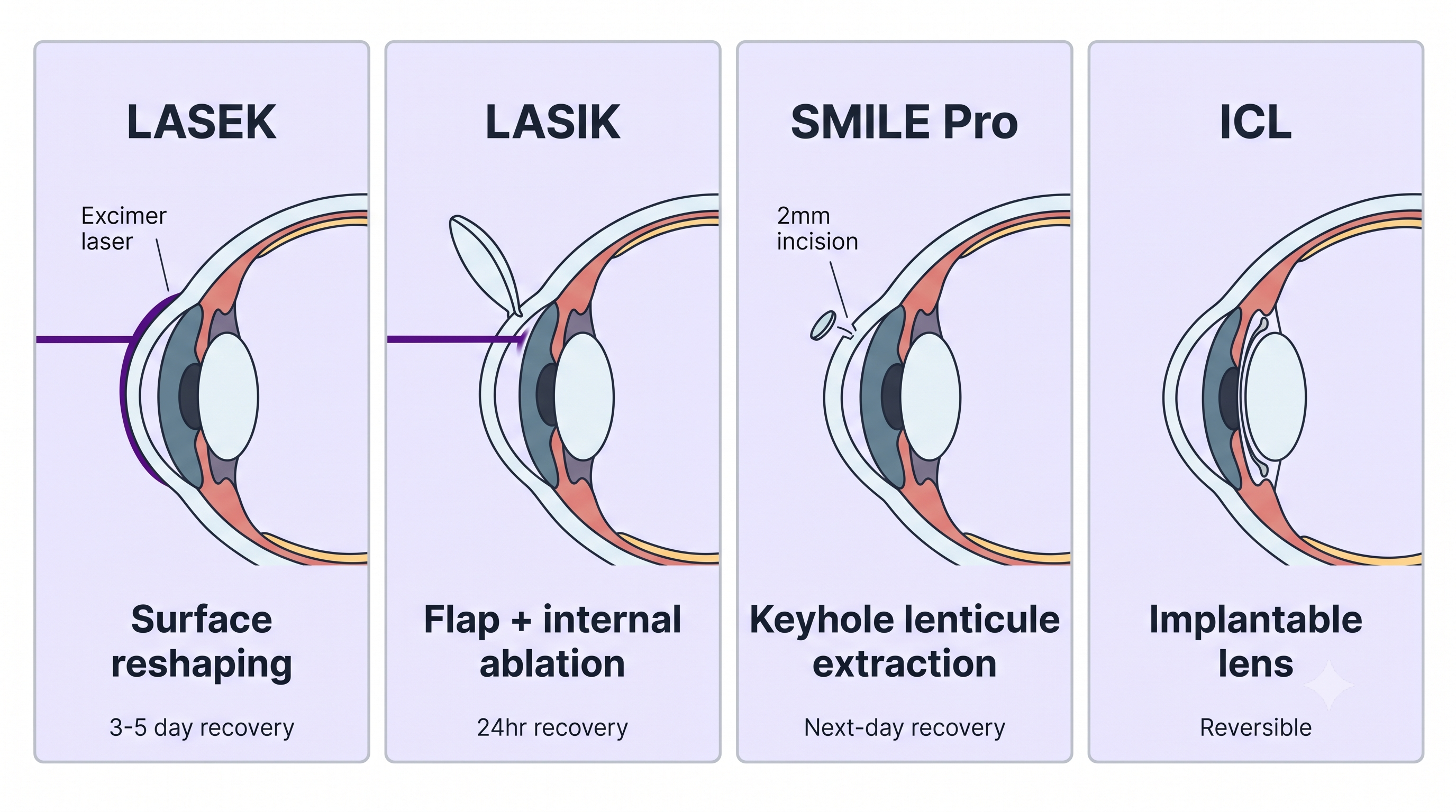 Medical diagram comparing LASEK vs LASIK vs SMILE Pro vs ICL vision correction procedures — cross-section eye illustrations showing surgical differences and recovery timelines for Korea eye clinics