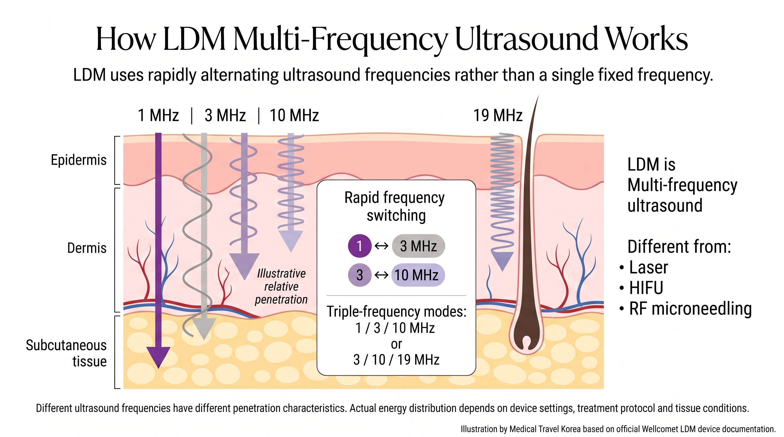 How LDM multi-frequency ultrasound works using 1, 3, 10 and 19 MHz with illustrative relative skin penetration