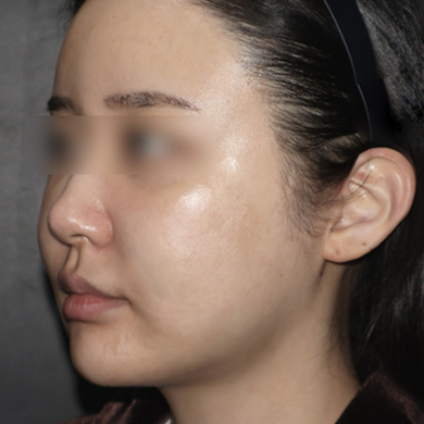 Before image from a clinic-provided lifting case at The Sinsa Clinic
