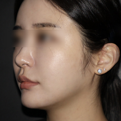 Three-month after image from a clinic-provided lifting case at The Sinsa Clinic